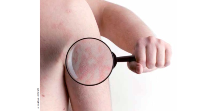 Eczéma et stress, une relation établie ?