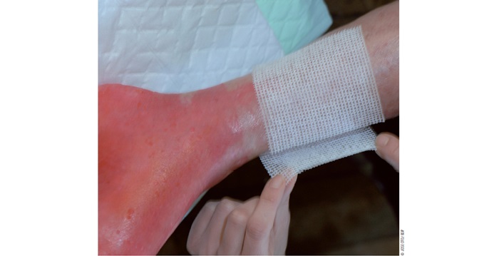 Pansements : des lignes génériques mais pas de substitution