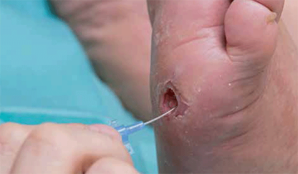 Traitement médical d’une plaie du pied diabétique