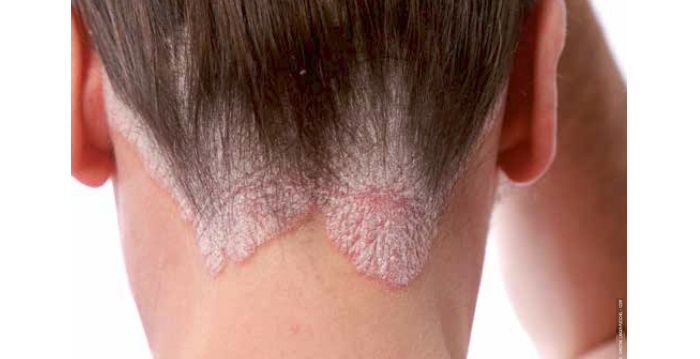 Psoriasis, ses formes et ses traitements