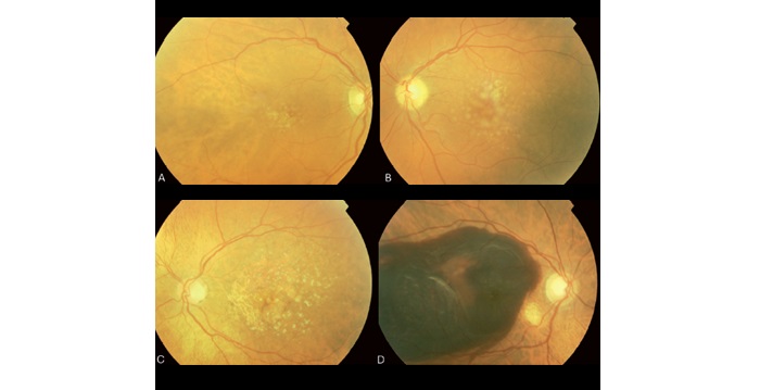 Comment prévenir la DMLA ?