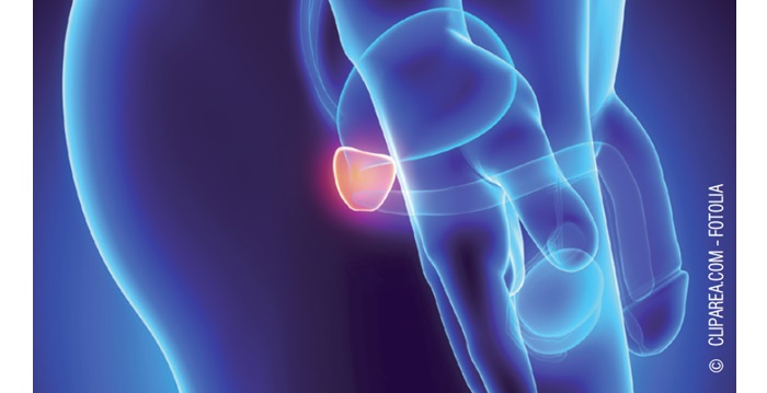 Un médicament anti-VIH efficace contre les métastases du cancer de la prostate