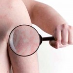 Acheter Eczéma et stress, une relation établie ? Eczéma et stress, une relation établie ?