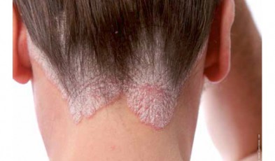 Les herbes pour le psoriasis