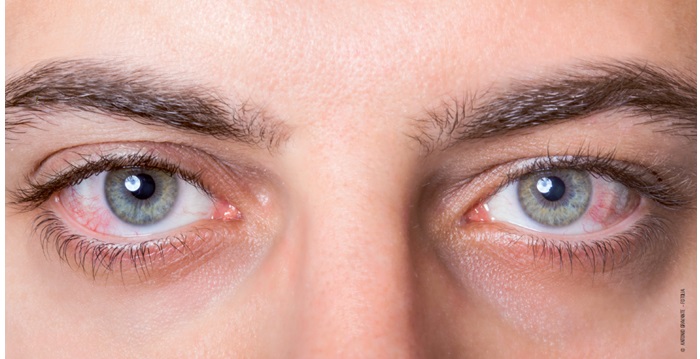 « J’ai les yeux irrités »