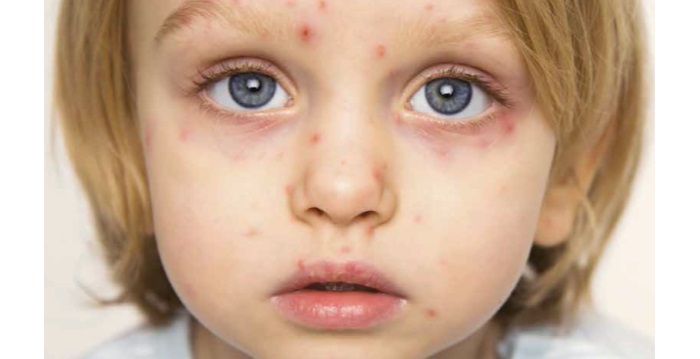 Varicelle, zona : un virus, deux pathologies