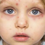 Acheter Varicelle, zona : un virus, deux pathologies Varicelle, zona : un virus, deux pathologies