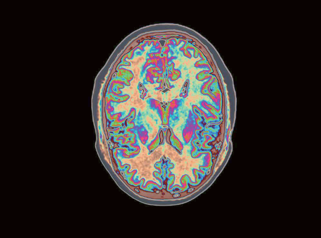 Maladie d’Alzheimer : les traitements font-ils leurs preuves ?