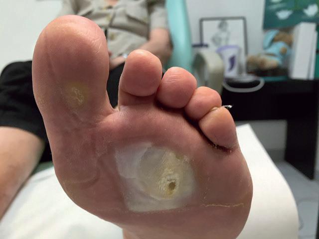 Le pied diabétique : une véritable plaie