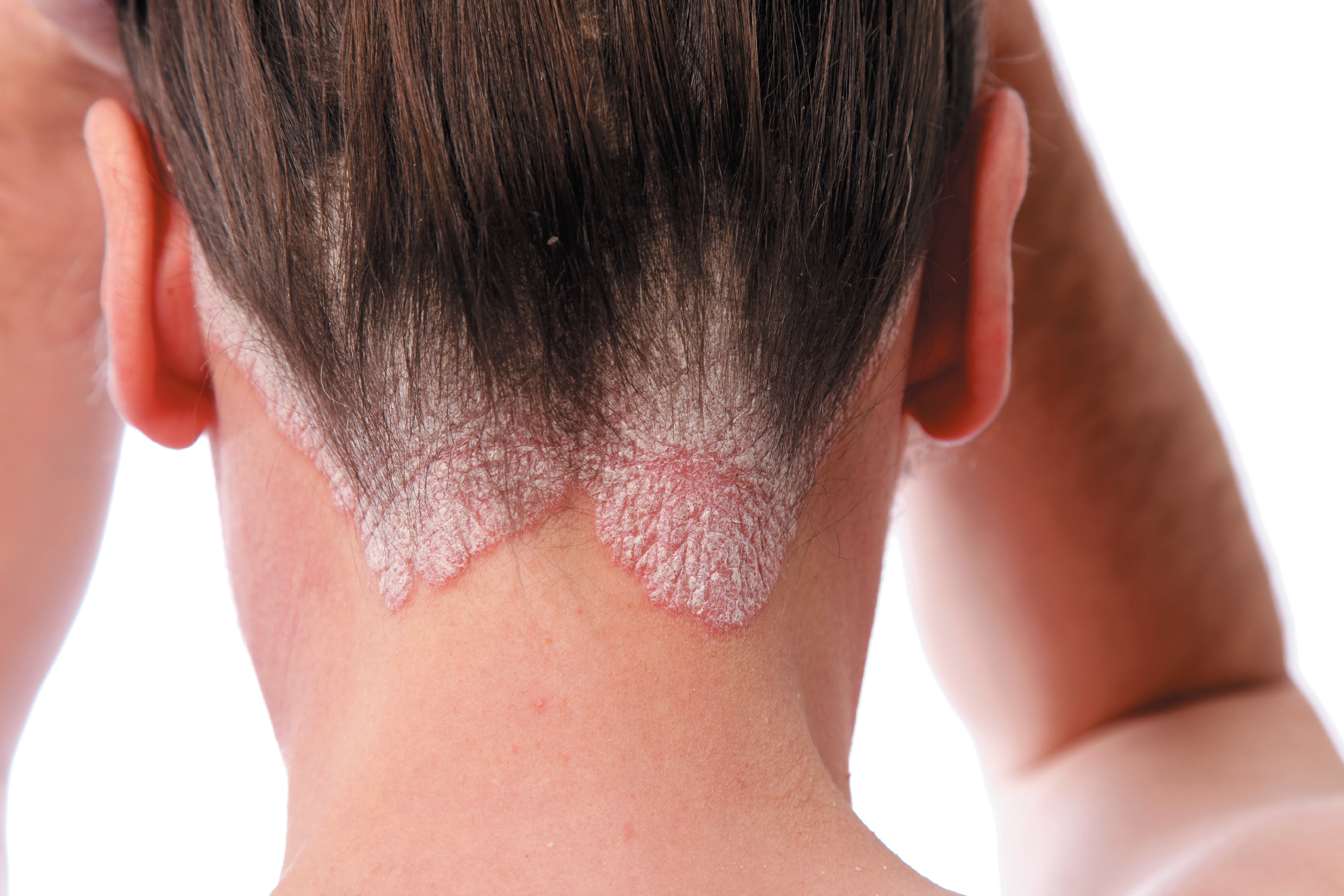 Le psoriasis
