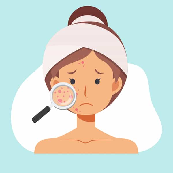 Acné : le point sur les traitements oraux