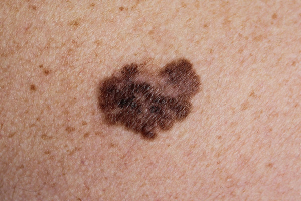 Acheter Est-ce un cancer de la peau ? Est-ce un cancer de la peau ?