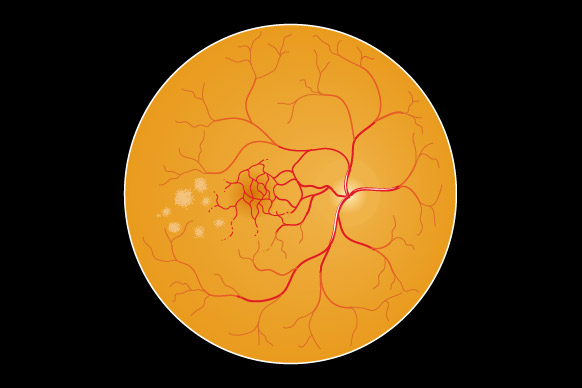 DMLA : entre espoirs et déceptions