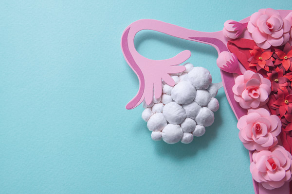 Les ovaires polykystiques