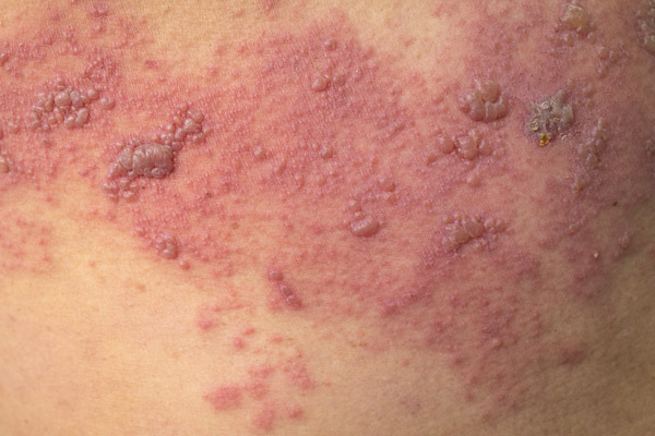 “ J’ai un zona, que faire ? ”