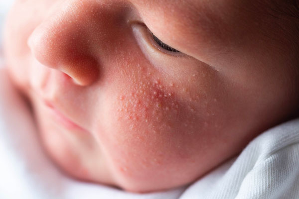 Acheter Problèmes de peau du tout-petit Problèmes de peau du tout-petit