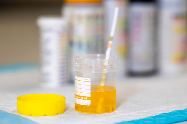 Infections urinaires à l’officine : ça bouge… lentement